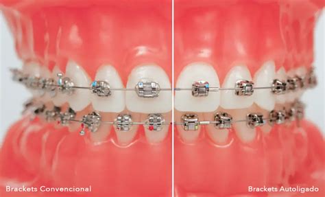 brackets metalicos y autoligables|cómo funcionan los brackets.